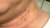 Hỏi đáp Y học: Thịt dư da (Skin tags)